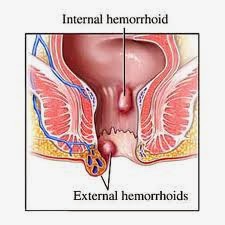Ambeien Internal Ambeien Internal
