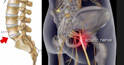 Millions of Americans Suffer From Constant Sciatica Pain – Here’s HOW To Reverse It!