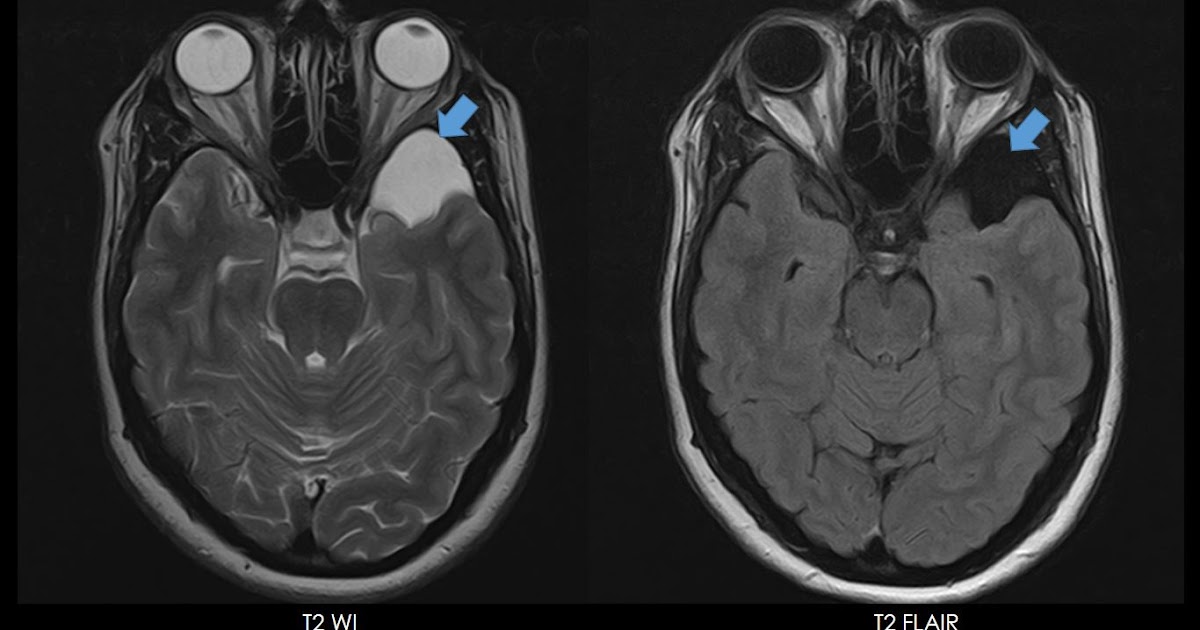 Ultimate Radiology Intracranial Arachnoid Cyst Galassi Type I