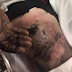 Man suffers third degree burns after e-cigarette battery explodes in his pocket 