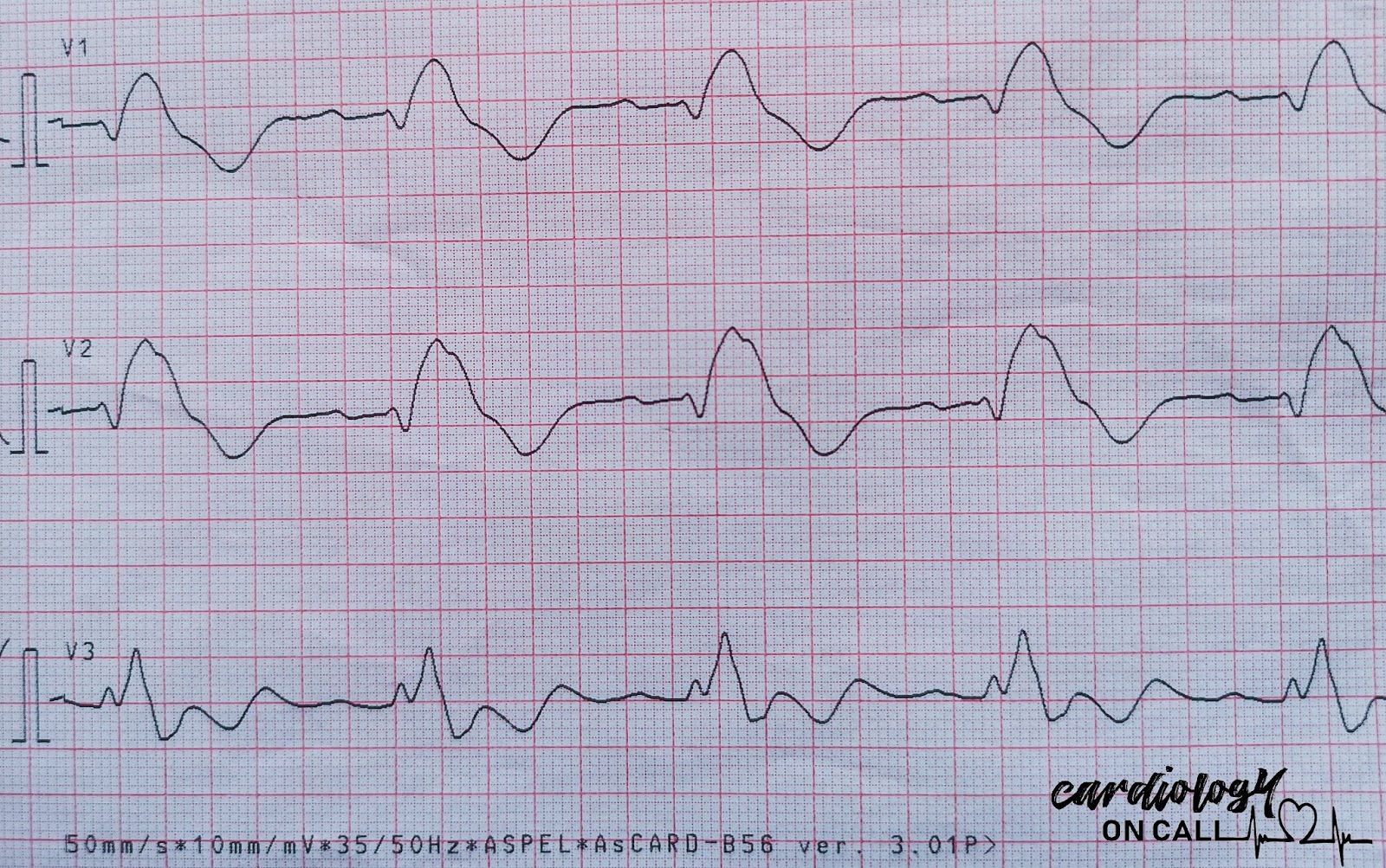 case-shark-fin-sign-true-killer-among-ecg-ischemic-patterns