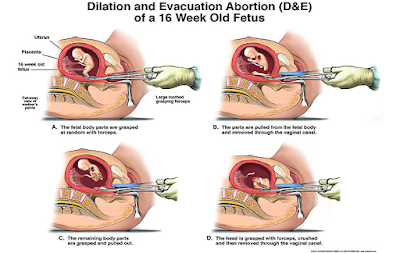 deabortion11.png