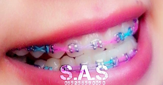 25 Populer Warna Karet Behel Yang Bagus