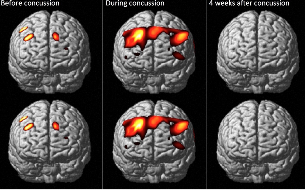 Montclair High School Bio Blog Can Concussion Affect You for the Rest of Your Life?