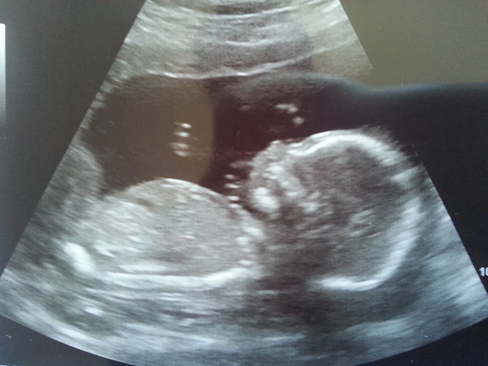 19 недель воды. 19 Неделя 2022. 19 Недель беременности фото. 5d Ultrasound 19 weeks.