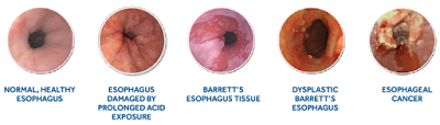 esophagus barrett barretts treatments