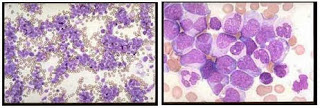 Leukemia Granulositik/Mielositik Kronik (LGK/LMK)