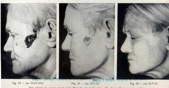 BioCeles. Curación energética LE. Caso Epitelioma grave.