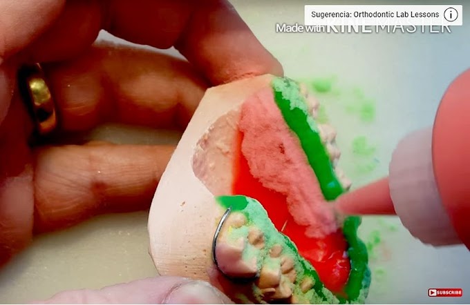 ORTHODONTIC RETAINERS: How to make a Watermelon Retainer (upper)