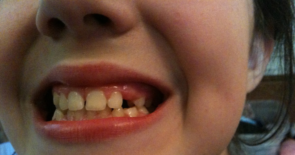 Diy False Teeth Do It Yourself Denture DIY Denture False Teeth Kit