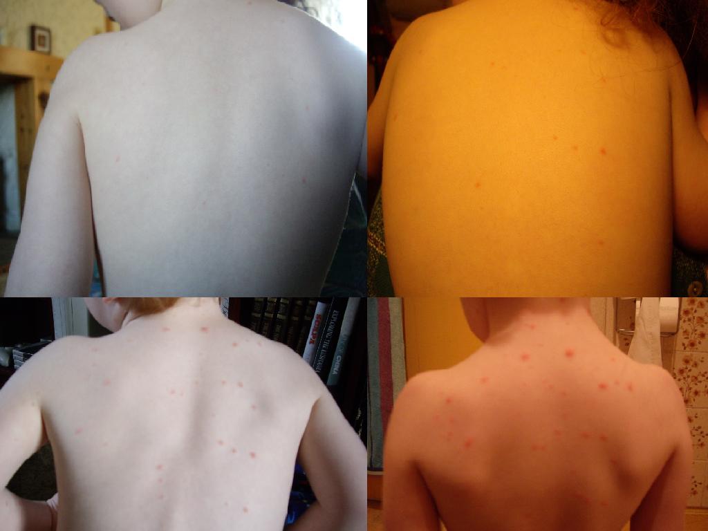 The Brick Castle Chicken Pox for Beginners....