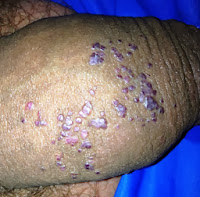Spots On End Of Penis 59