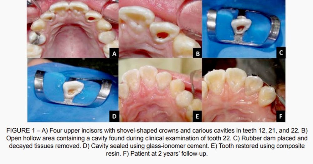 PDF Conservative treatment of shovelshaped upper incisors and Dens