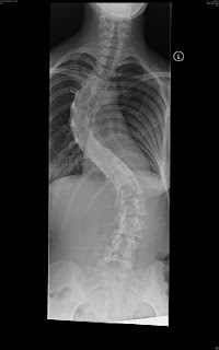 My scoliosis xray before scoliosis surgery
