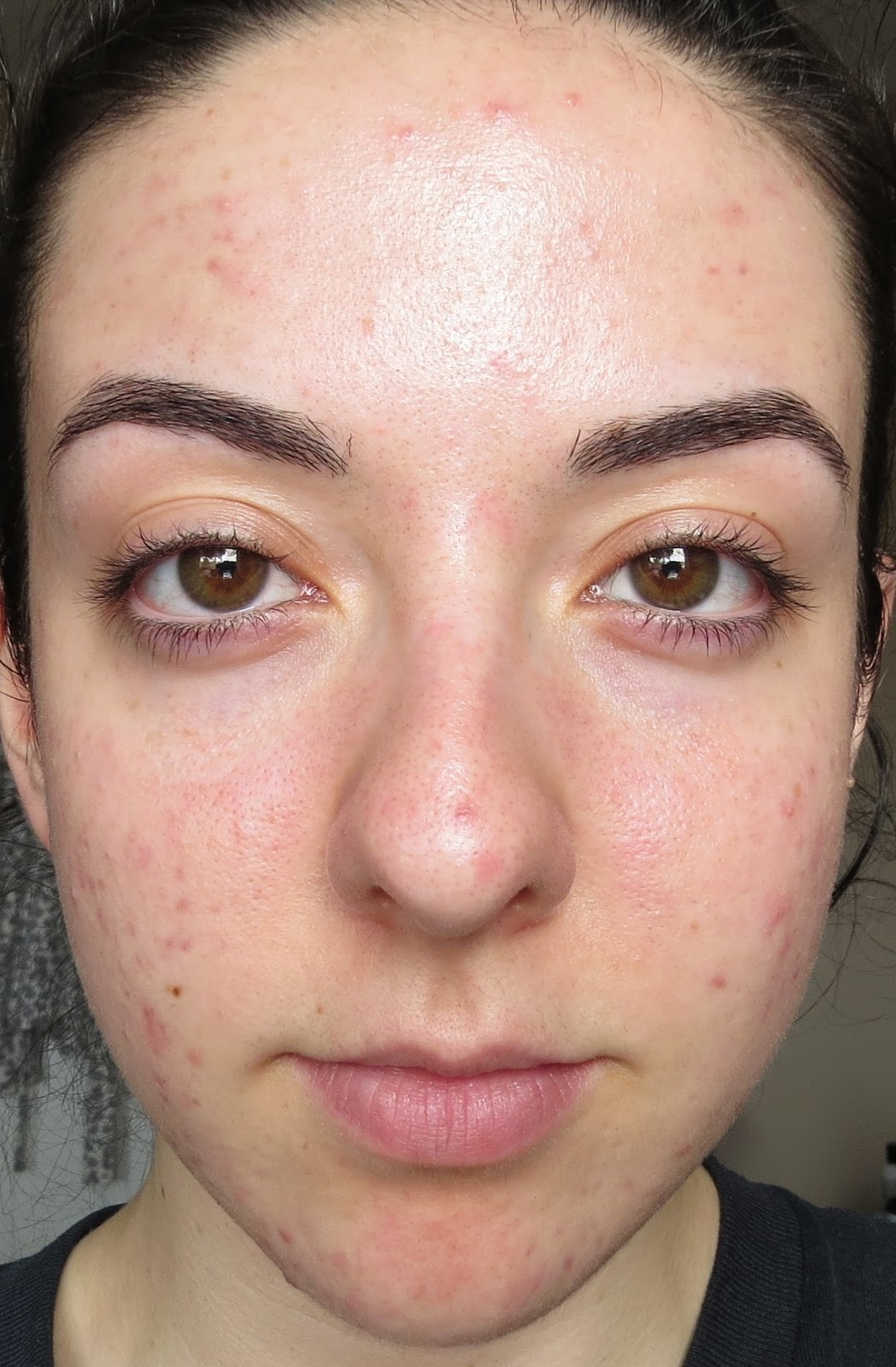 My Skin's Journey BioOil Skincare Oil DUPE!?