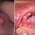 Cara Mencegah Virus Hepatitis B thumbnail