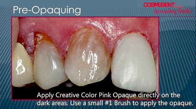 COMPOSITE VENEERS: Layer that counts - Clinical Case