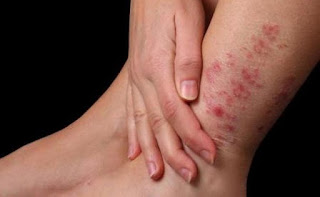 the causes of dermatitis