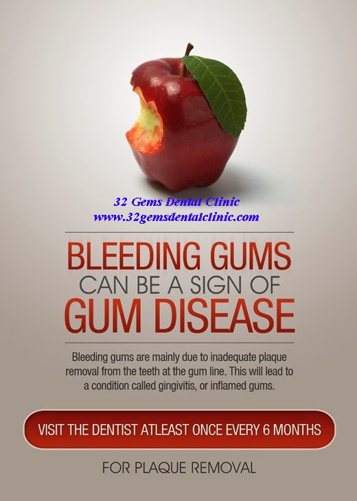 Bleeding Gums can be sign of Gums Disease.................