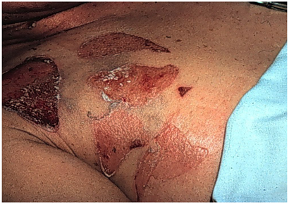 Symptoms of Staph Infection | MRSA Symptoms | Signs of MRSA