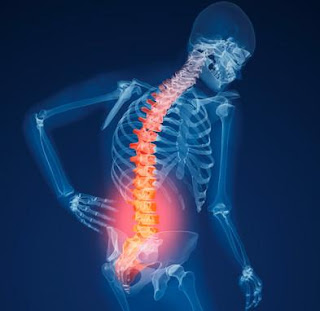 Osteoporosis