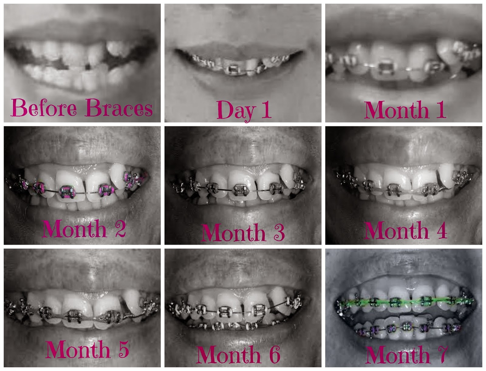 Adult Braces My Journey