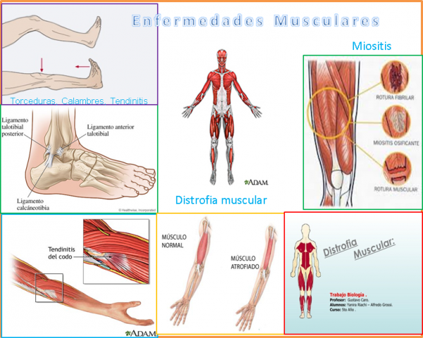 Hipertiroidismo y dolores musculares