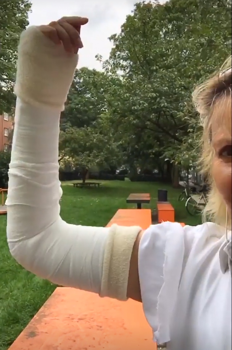 Arm Gebrochen Gips Wie Lange Speichenbruch Distale