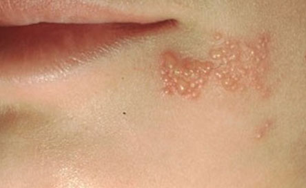 Tratamientos naturales para el herpes
