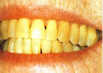 kenapa gigi berwarna kuning? - unic indonesia