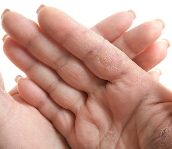 جفافُ اليدين وجفاف الجلد على الجسم