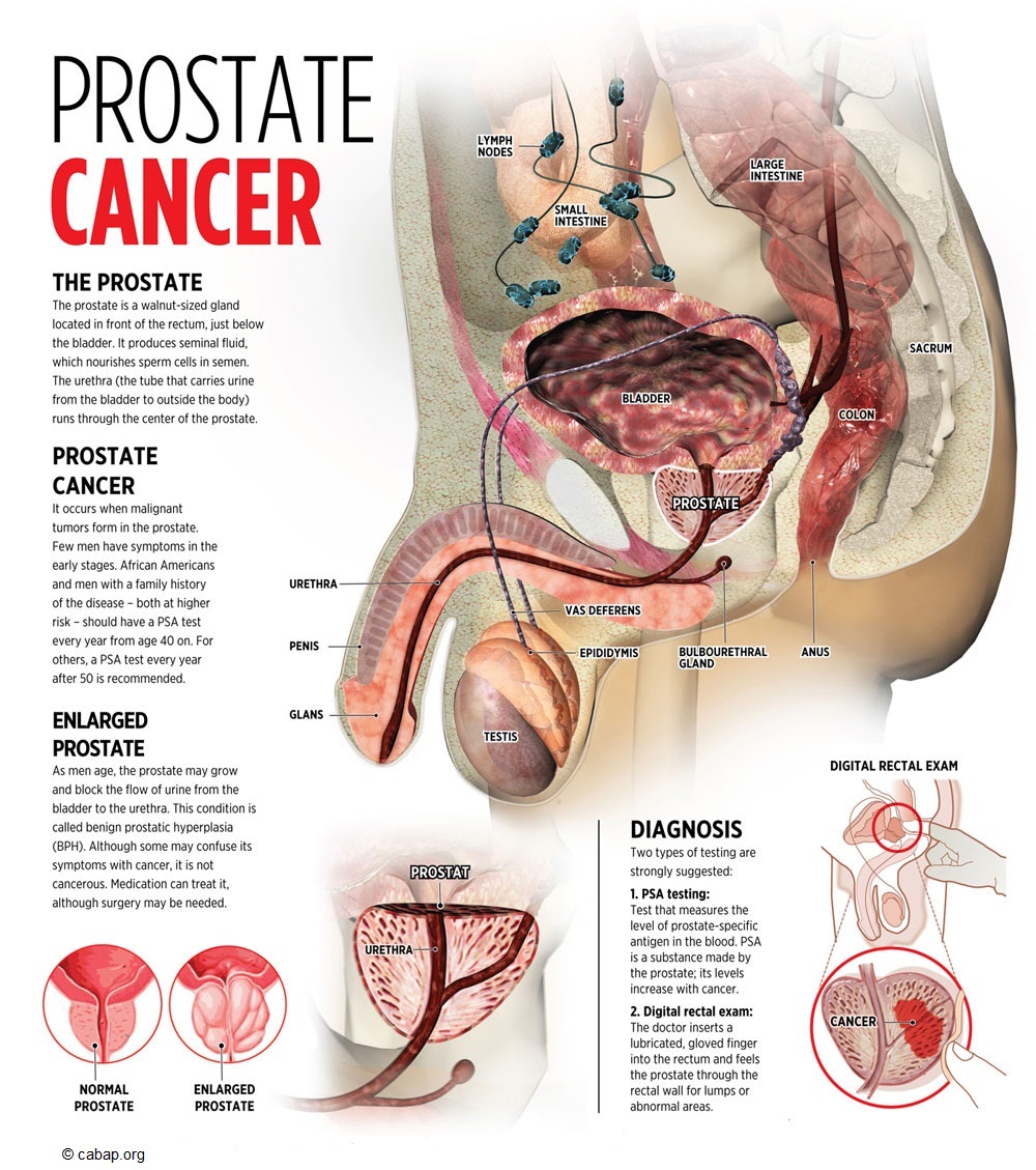 Prostatitis a latinul)