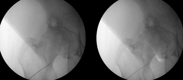 Air Arthrogram Right Hip Joint Injection