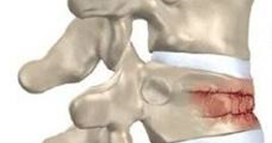 Клиновидный компрессионный перелом позвоночника l1. Компрессионный перелом позвоночника th12 l3. Компрессионный перелом l2 второй степени. Компрессионный клиновидный перелом позвонка. Компрессионный перелом л3 л4.