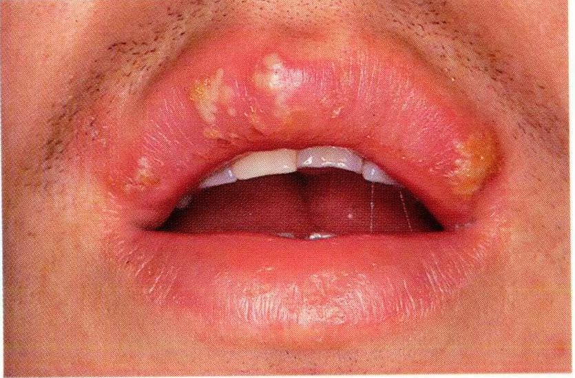Oral Herpes Symptoms and Causes of Cold Sores