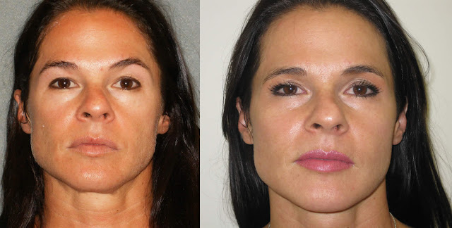 Get Young Look Again by Using Sculptra the Liquid Facelift