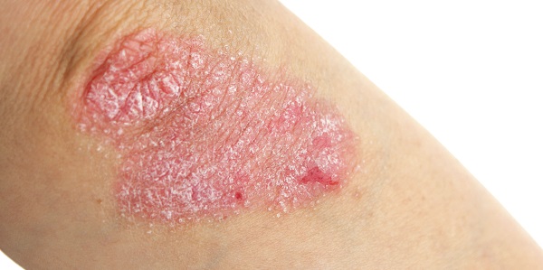 Leczema che trattare farmaci
