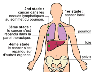 #thelancetoncology #cancerdupoumon #CBNPC #necitumumab #gemcitabine #cisplatine Necitumumab plus gemcitabine cisplatine versus seule comme traitement première intention chez patients atteints cancer poumon