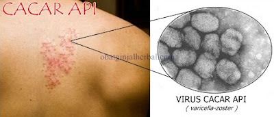 Cara Mengobati Cacar Api Secara Alami dengan Obat Tradisional Cara Mengobati Cacar Api Secara Alami dengan Obat Tradisional