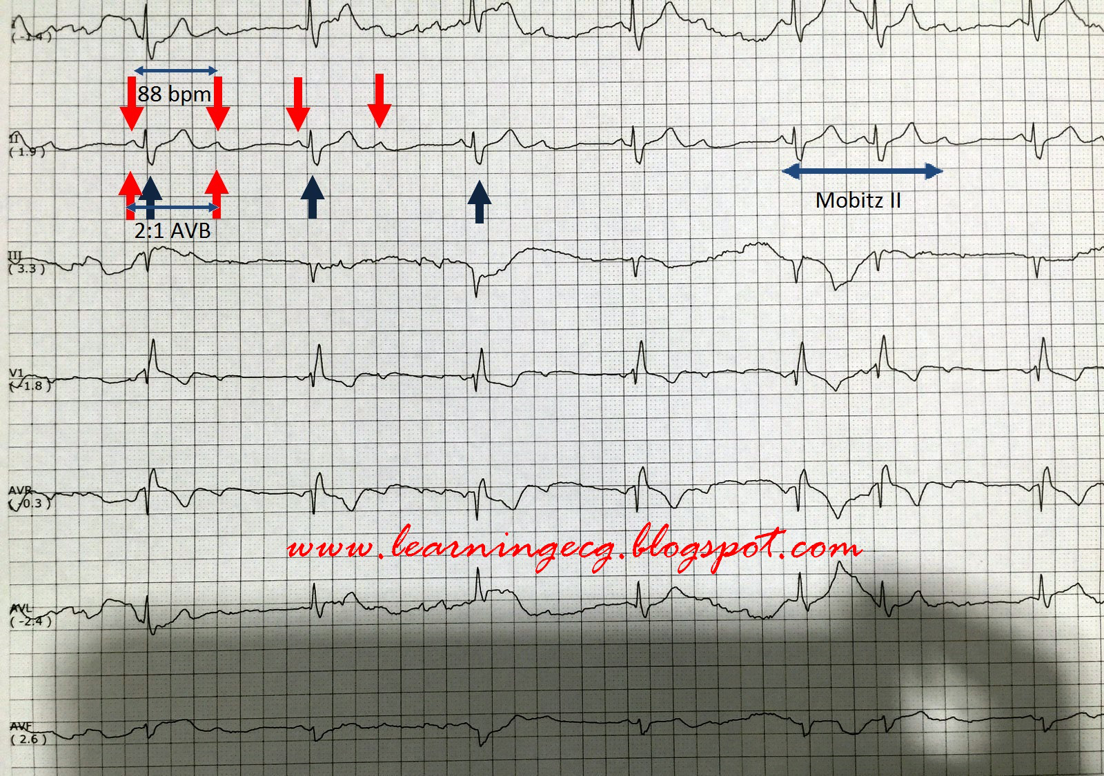 ECG Rhythms Sinus rhythm, 21 AV block due to Mobitz II ECG Rhythms Sinus rhythm, 21 AV block due to Mobitz II