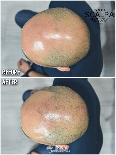 Before and After 1st Scalp Micropigmentation (SMP) treatment 