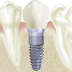 Dental Implants:  The Game Changer