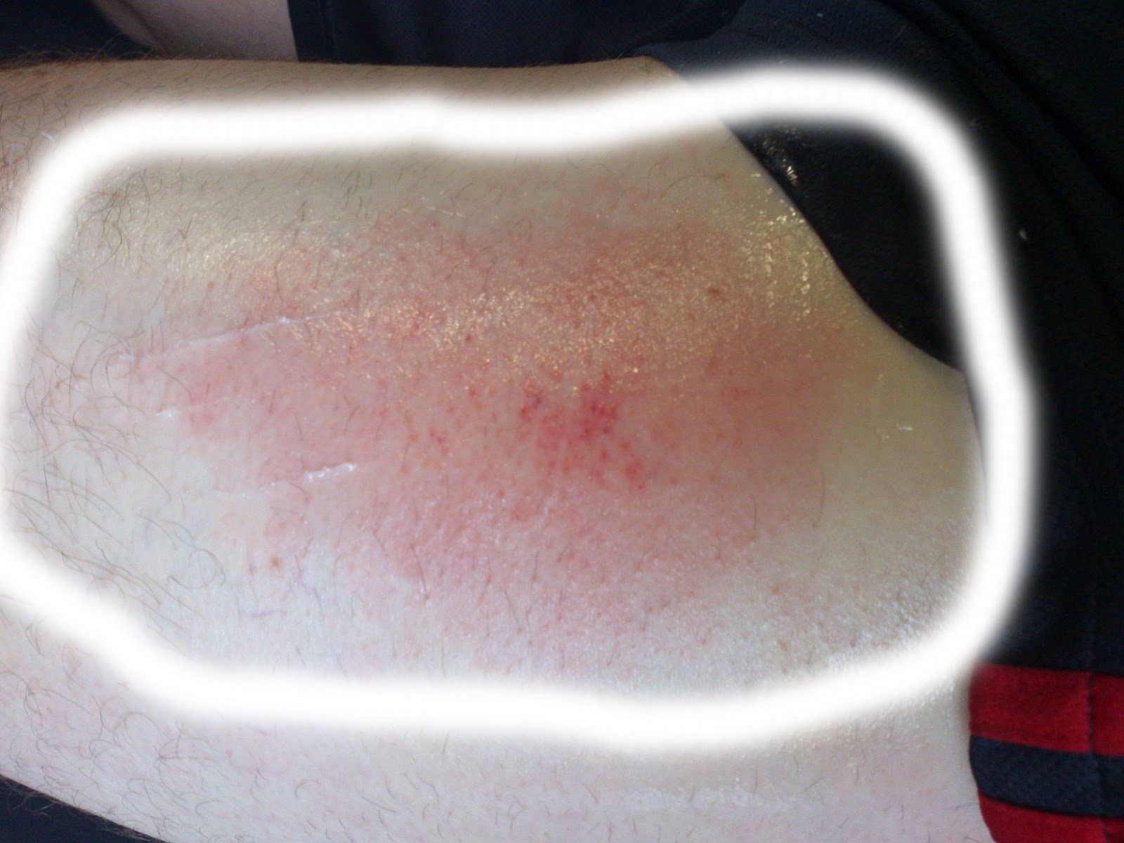 Case of the Week 62512 The Quad "Strain" Modern Manual Therapy