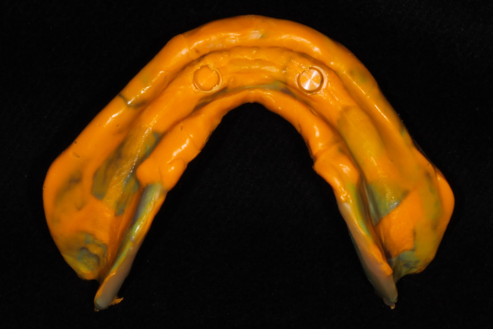 Boise Idaho Prosthodontics Maxillary Complete Denture and Mandibular