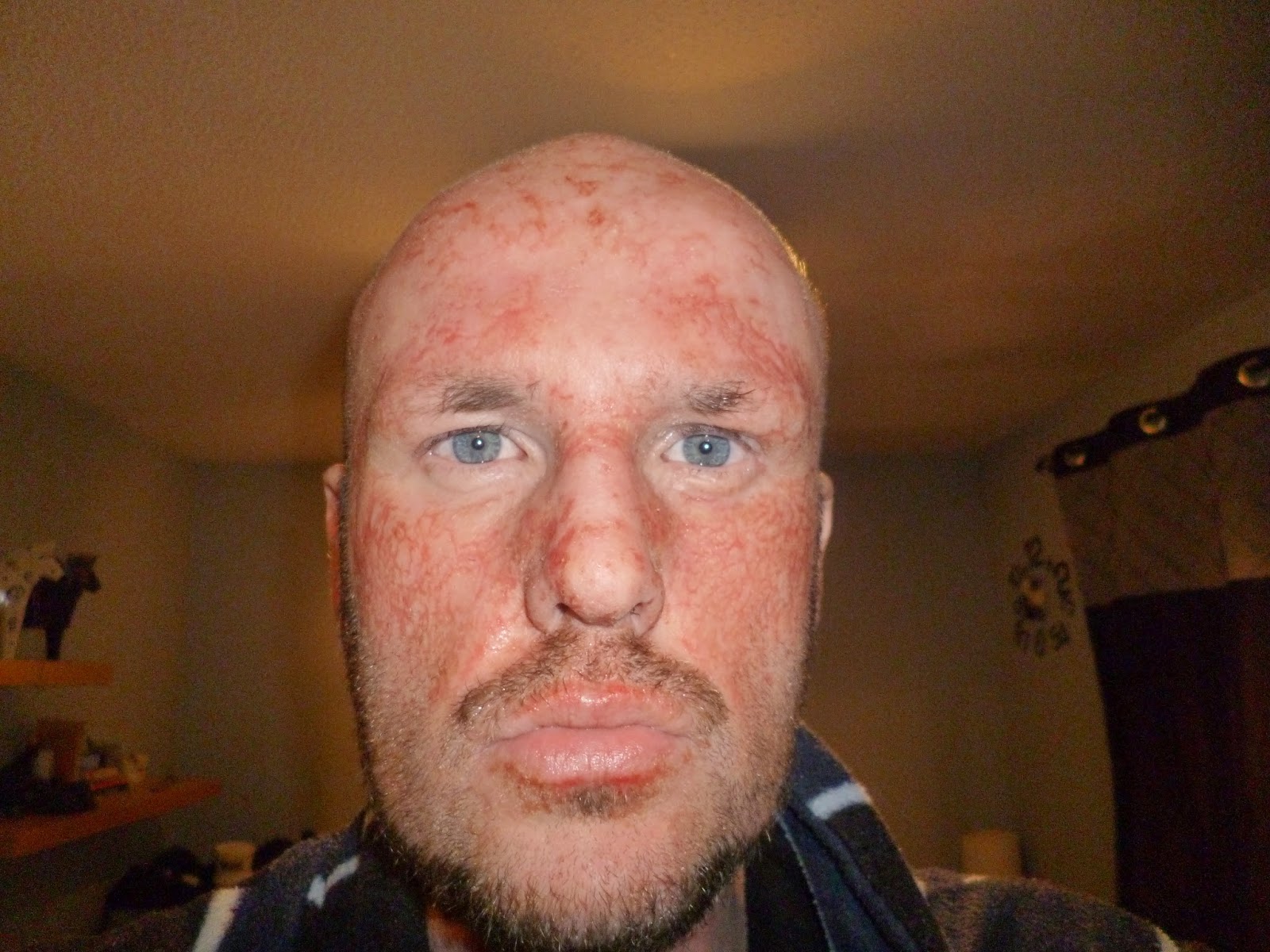 The Age Of Skin Liberation Topical Steroid Withdrawal October 2014