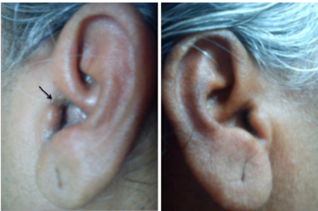 التهاب-الأذن-الخارجية
