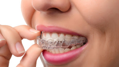 Kỹ thuật niềng răng không mắc cài 3D Clear