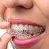 Kỹ thuật niềng răng không mắc cài 3D Clear