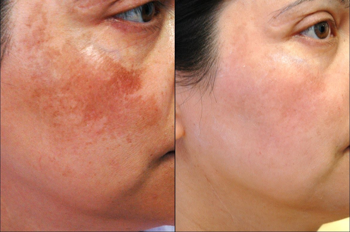 home-remedy-for-skin-pigmentation-cure-by-dr-bilquis-sheikh