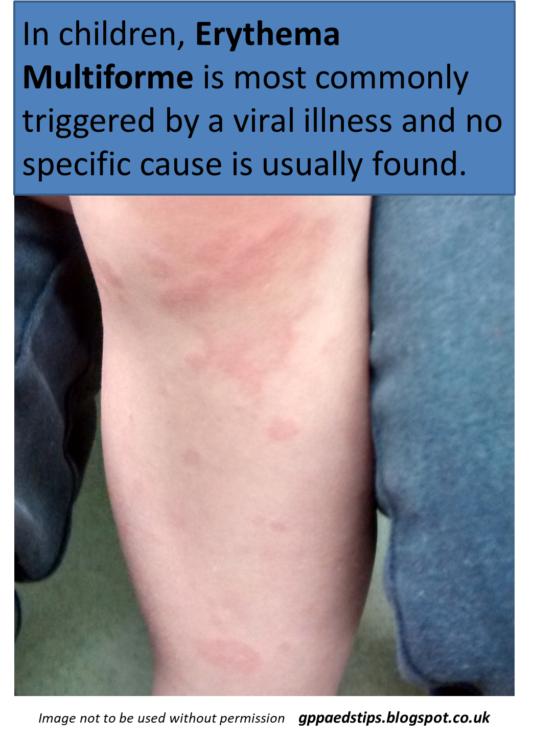 Paediatrics For Primary Care (and Anyone Else) Rashes In Children 052